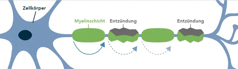 Darstellung der Übermittlung von Nervenimpulsen mit intakter Myelinschicht vs. Die gestörte Übermittlung bei geschädigter Myelinschicht. 