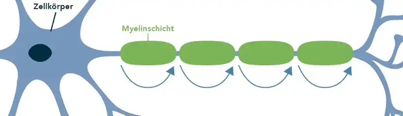 Darstellung der Übermittlung von Nervenimpulsen mit intakter Myelinschicht vs. Die gestörte Übermittlung bei geschädigter Myelinschicht. 